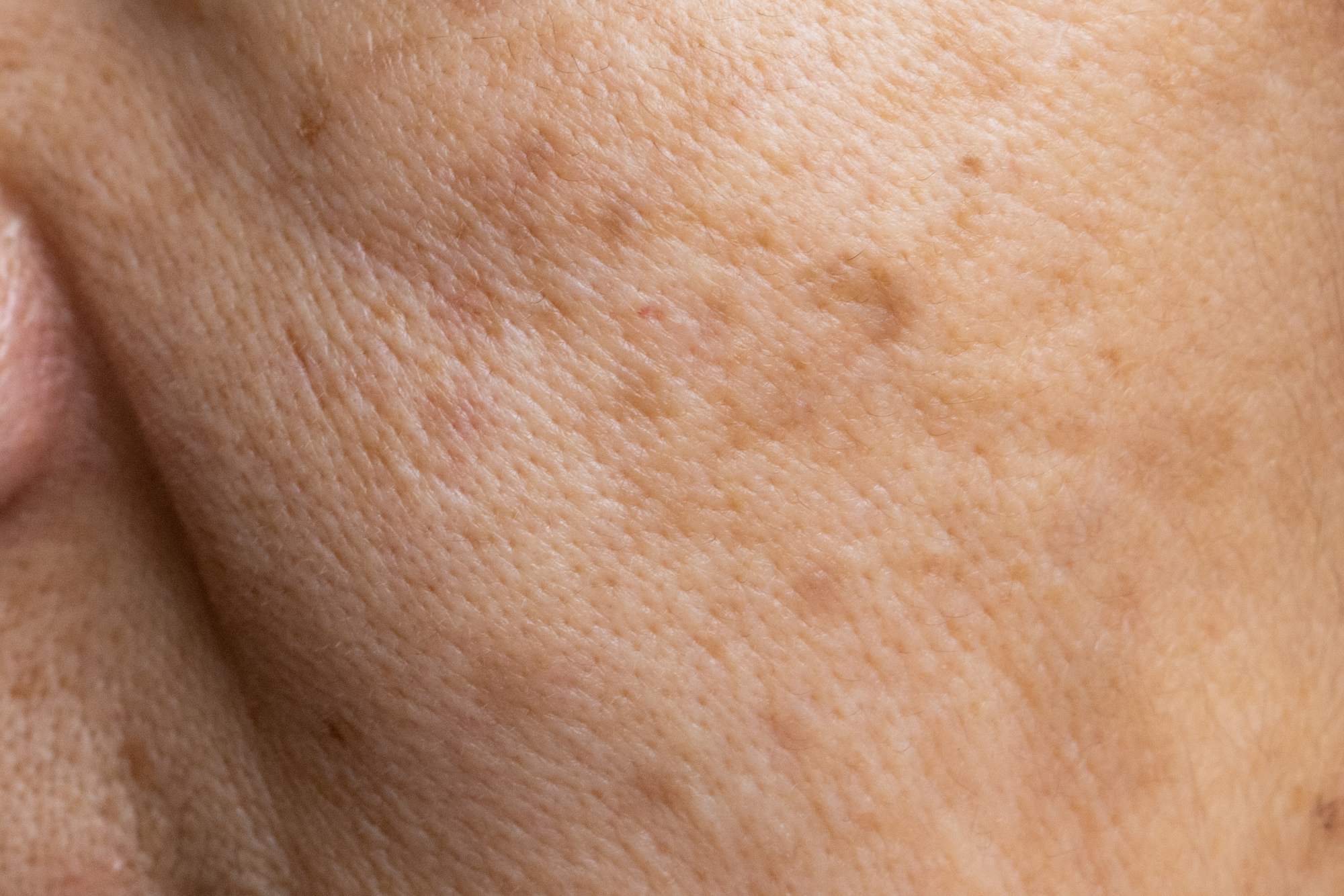 Why Is My Pigmentation Getting Worse?